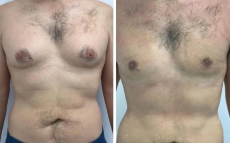 Understanding Gynecomastia in Dubai: Causes and Solution Guide
