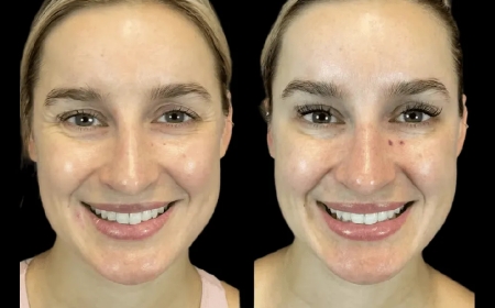 The Rise of Male Botox: What the Best Doctors in dubai Are Saying