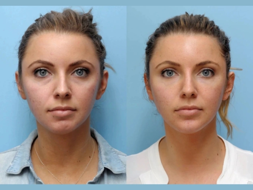 The Best Plastic Surgeon in Dubai Answers Common Questions About Thread Lifts