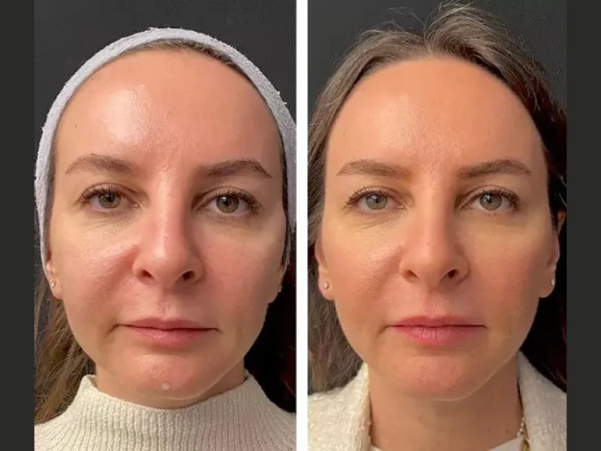 How Often Should You Get Mesotherapy? The Best Plastic Surgeon in Dubai Explains