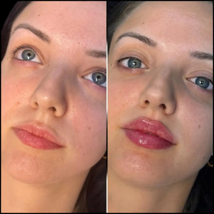 Why Choose Fillers Treatment in Dubai for Lip Enhancement?