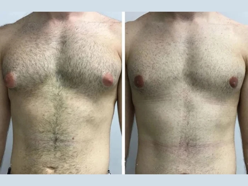 Top Mistakes to Avoid When Choosing the Best Gynecomastia Surgeons in Dubai