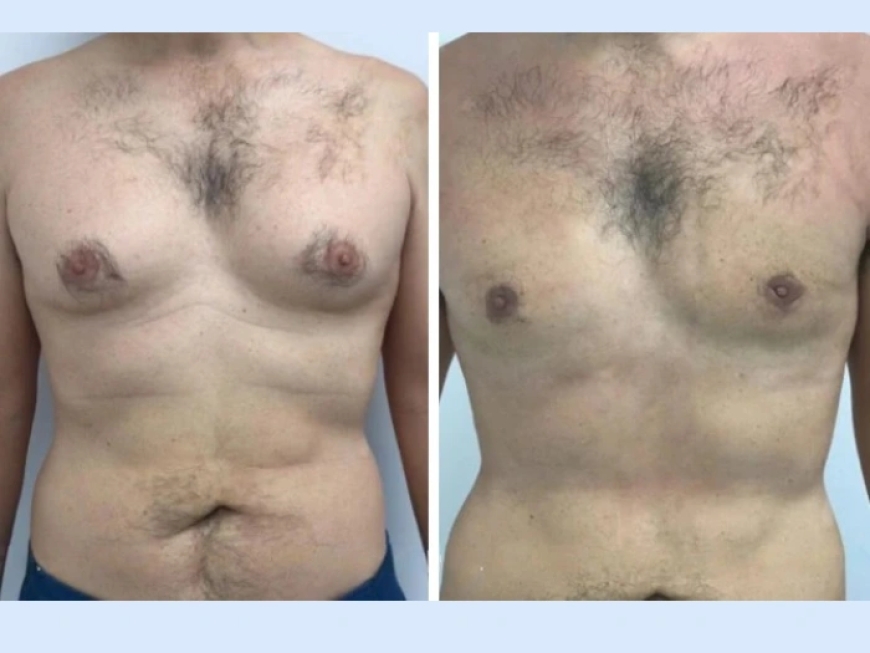 Understanding Gynecomastia in Dubai: Causes and Solution Guide