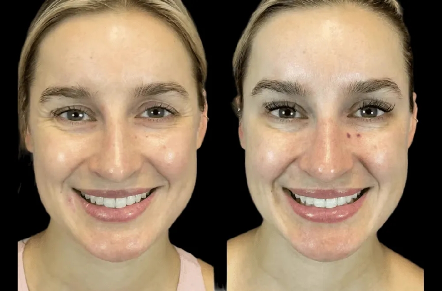 The Rise of Male Botox: What the Best Doctors in dubai Are Saying