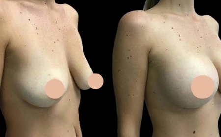 Experience Luxury Breast Augmentation Surgery in Dubai