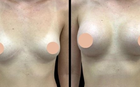 Breast Augmentation Surgery in Dubai: Implant Placement – Under or Over the Muscle