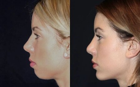 Best Aesthetic Clinic in dubai for Chin Fillers: The Role of Experienced Doctors