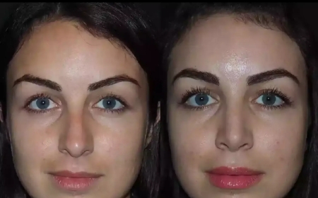 Best Doctors in Dubai for Rhinoplasty: Where Art Meets Medical Science