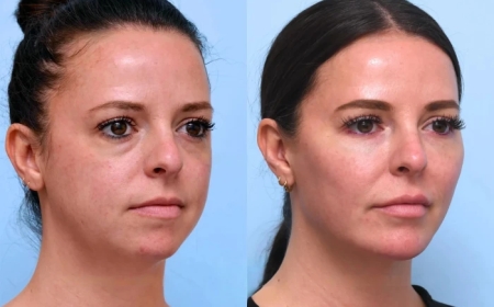 Before and After: Thread Lift Transformations by the Best Plastic Surgeons in Dubai