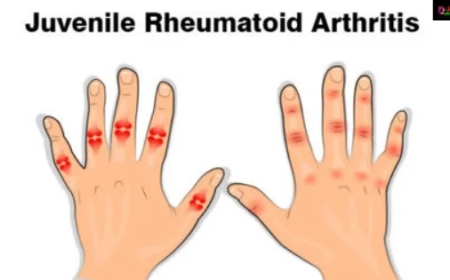 Brufen 400 mg for Fever: When and How to Use It