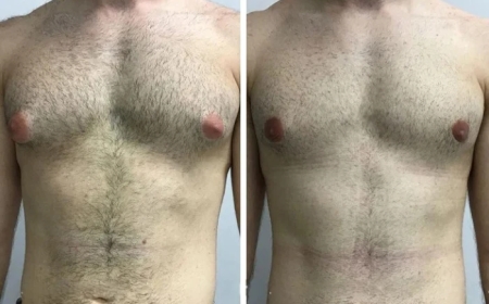 What Makes Gynecomastia in Dubai a Preferred Choice for Medical Tourists?