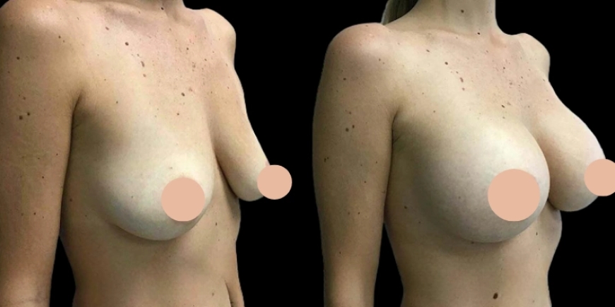 Experience Luxury Breast Augmentation Surgery in Dubai