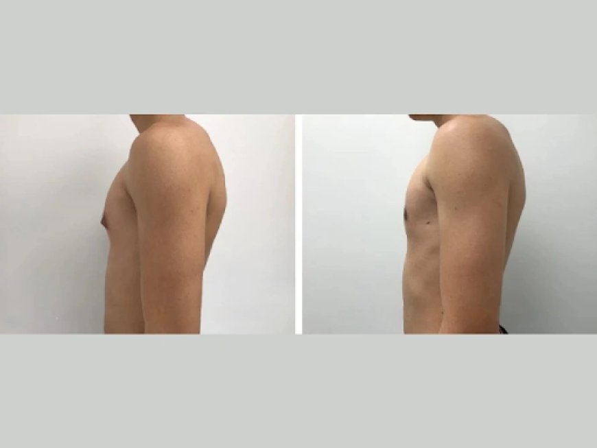Dealing with Gynecomastia as a Teen in Dubai