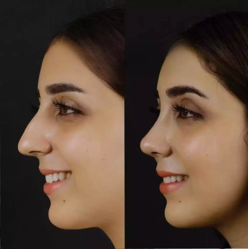 Navigating Septoplasty? Trust Only the Best Doctors in Dubai