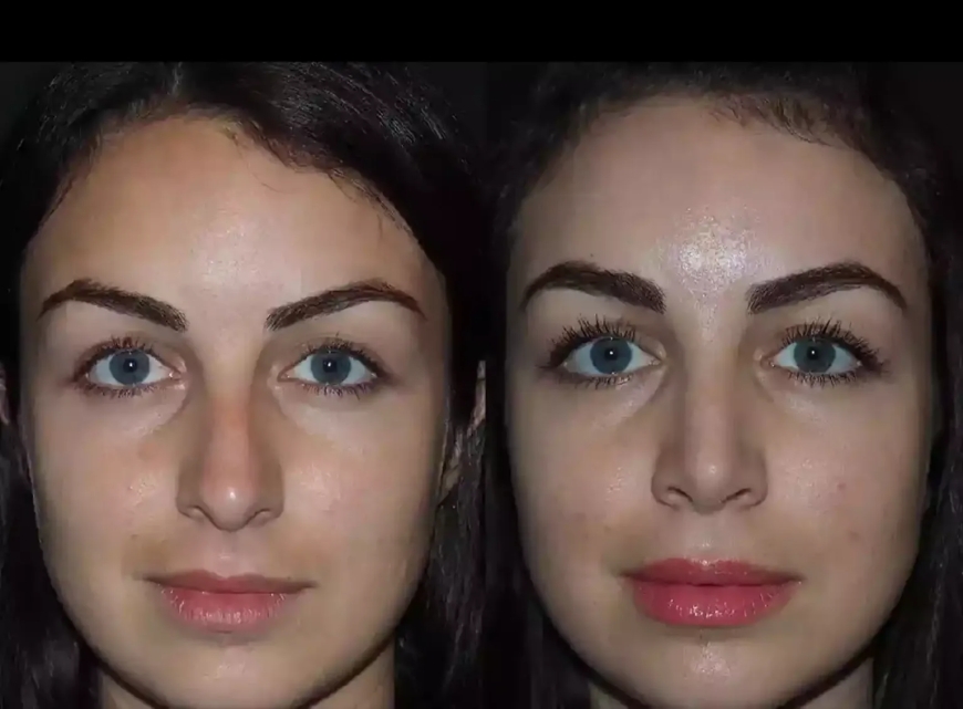 Best Doctors in Dubai for Rhinoplasty: Where Art Meets Medical Science