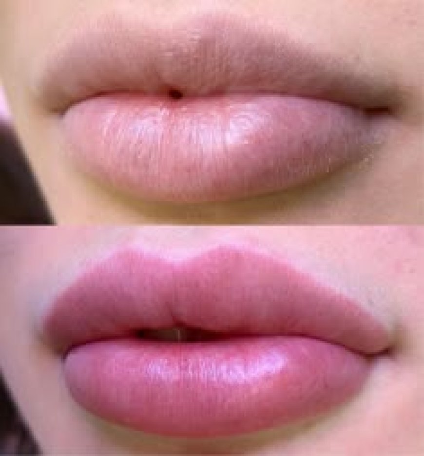 Die wachsende Popularität natürlicher Lippeninjektionen