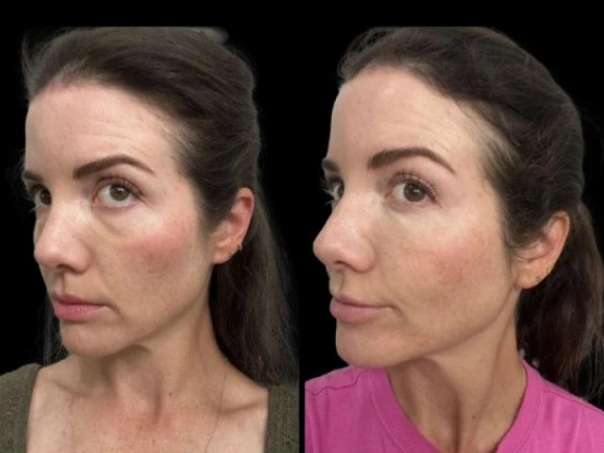 Dark Circles Be Gone: How the Best Doctors in Dubai Can Help You Look Refreshed