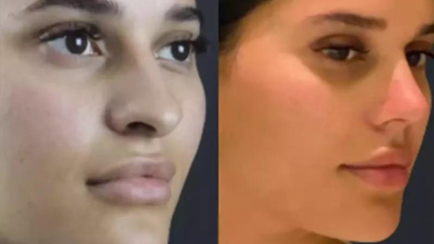 The Future of Nose Surgery in Dubai: 3D Imaging & Precision