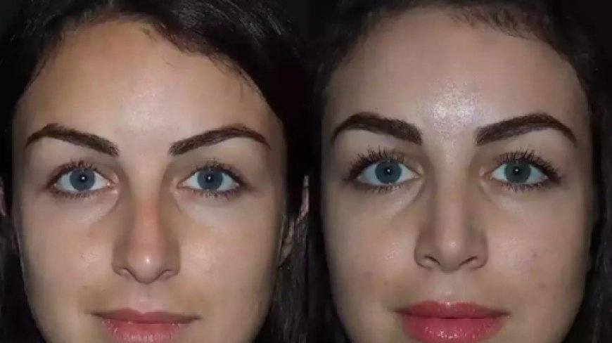 Breathe Easy: Nose Deviated Septum Surgery in Dubai Explained